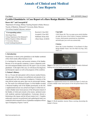 Annals of Clinical and Medical
Case Reports
Case Report ISSN: 2639-8109 Volume 8
Cystitis Glandularis: A Case Report of a Rare Benign Bladder Tumor
Douro AK1,2*
and Lmezguidi K3
1
Department of Urology, Military Teaching Hospital in Rabat, Morocco
2
Faculty of Medicine, Mohamed V University, Rabat, Morocco
3
3rd military hospital Laâyoune, morocco
*
Corresponding author:
Akim Kogui Douro,
Urology Department of the Mohamed V
Military Hospital in Rabat, Mohamed
V- University, Morocco,
E-mail: kamkogui2@yahoo.fr
Received: 11 Jan 2022
Accepted: 21 Jan 2022
Published: 28 Jan 2022
J Short Name: ACMCR
Copyright:
©2022 Douro AK. This is an open access article distribut-
ed under the terms of the Creative Commons Attribution
License, which permits unrestricted use, distribution,
and build upon your work non-commercially.
Citation:
Douro AK, Cystitis Glandularis: A Case Report of a Rare
Benign Bladder Tumor. Ann Clin Med Case Rep. 2022;
V8(7): 1-3
1. Introduction
Pseudotumor or florid cystitis glandularis is the bladder urothelial
of the which mainly affects humans [1,2,3].
It is facilitated by chronic and recurrent irritation of the bladder.
Because of its non-specific symptoms, it poses a diagnostic prob-
lem with malignant bladder tumors [4]. We report 1 case of cystitis
glandularis. In the light of this case, we will discuss the diagnostic
and therapeutic aspects as well as the prognosis of this condition.
2. Patient’s History
He is a 32-year-old male patient with no known medical history,
the main signs of the disease were pollakiuria and episodes of un-
complicated renal colic resistance to analgesics; Urinalysis of the
urine did not isolate any germ, there was no microscopic hematu-
ria. The result of an ultrasound (Figure 1) of the bladder revealed
a thickened budding wall of the bladder prominently on the left,
a supplemented uroscan was carried out (Figure 2) which also re-
vealed a bladder tumor lesion process of the left postero-lateral of
the bladder, of which part extends to the meatus ipsilateral ureter
with moderate upstream hydronephrosis. Cystoscopy showed a
thickening at the trigone and the left peri-meatic level. Complete
endoscopic resection was performed, and a pathological study was
conducted which returned in favor of glandular metaplasia with no
sign of malignancy (Figures 3 and 4).
Figure 1: The result of an ultrasound of the bladder revealed a thickened
budding wall of the bladder prominently on the left
Figure 2: A supplemented uroscan was carried out (figure 2) which also
revealed a bladder tumor lesion process of the left postero-lateral of the
bladder
Figure 3: HEx40 glandular structure Mucus secreting dissociating the
bladder’s Chorion
http://acmcasereports.com 1
 