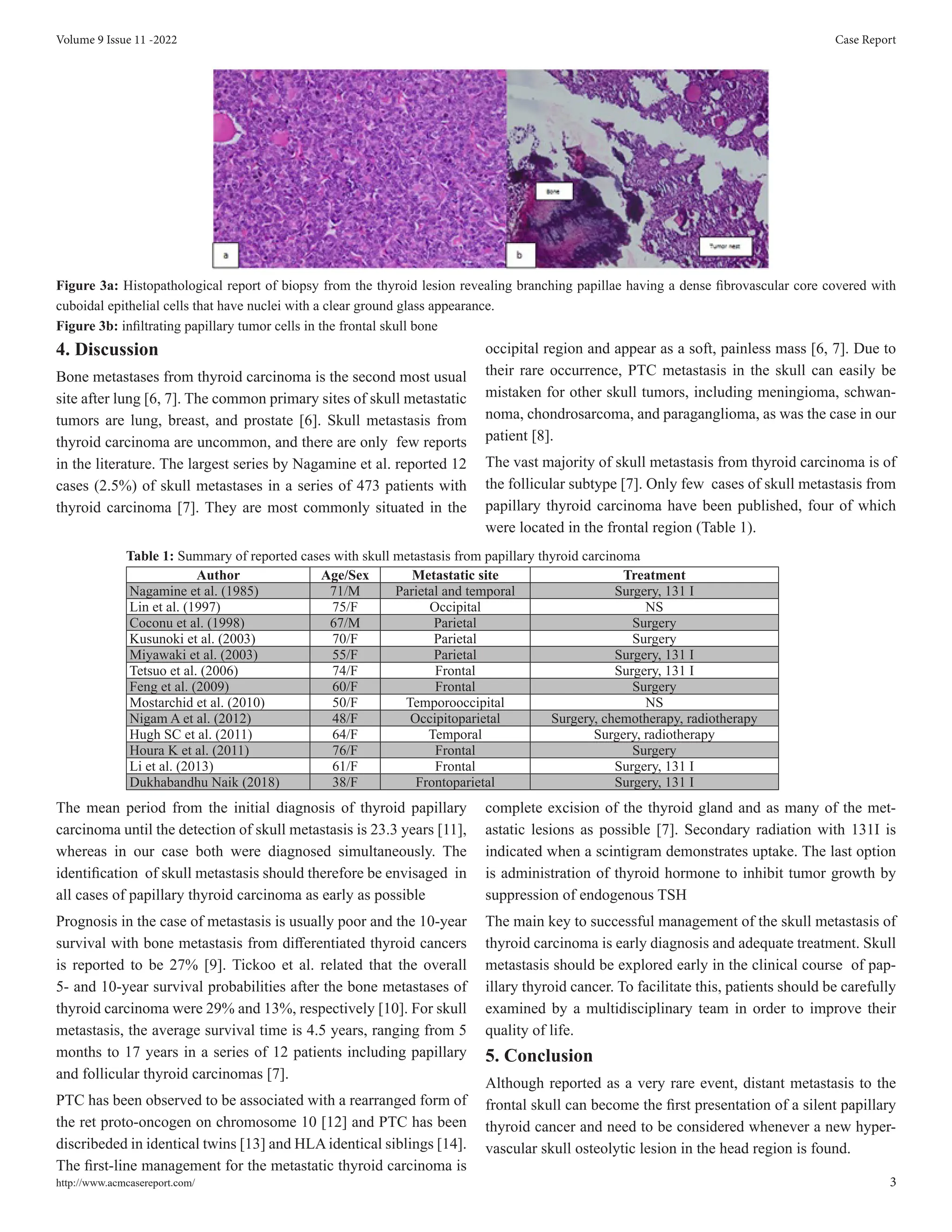 Skull Metastasis from Papillary Thyroid Carcinoma: Case Report and ...