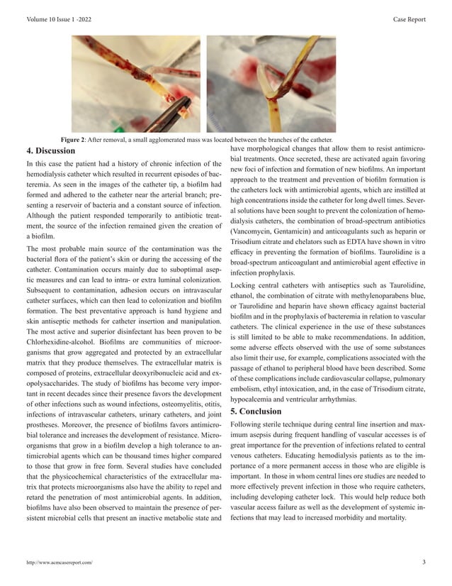 Chronic Infection Related To Tunneled Catheter for Hemodialysis with