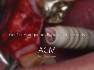 Get 1cc Autogenous Bone within Seconds
ACMAuto Chip Maker
 