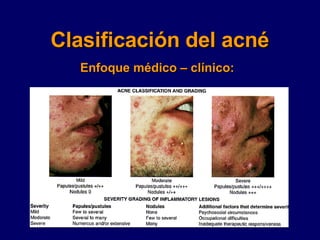 Clasificación del acné Enfoque médico – clínico: 