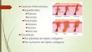 Lesiones inflamatorias:
Superficiales:
Pápulas
pústulas
Profundas:
Nódulos
Quistes
Máculas
Cicatrices:
Por pérdida de tejido colágeno
Por aumento de tejido colágeno
 
