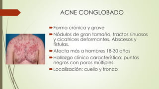 ACNE CONGLOBADO
Forma crónica y grave
Nódulos de gran tamaño, tractos sinuosos
y cicatrices deformantes. Abscesos y
fístulas.
Afecta más a hombres 18-30 años
Hallazgo clínico característico: puntos
negros con poros múltiples
Localización: cuello y tronco
 