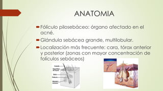 ANATOMIA
Fólículo pilosebáceo: órgano afectado en el
acné.
Glándula sebácea grande, multilobular.
Localización más frecuente: cara, tórax anterior
y posterior (zonas con mayor concentración de
folículos sebáceos)
 