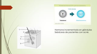 Hormona incrementada en glándulas
Sebáceas de pacientes con acné.
 