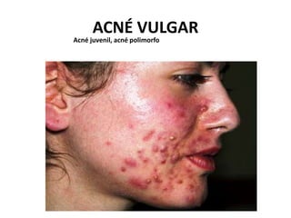 ACNÉ VULGAR
Acné juvenil, acné polimorfo
 