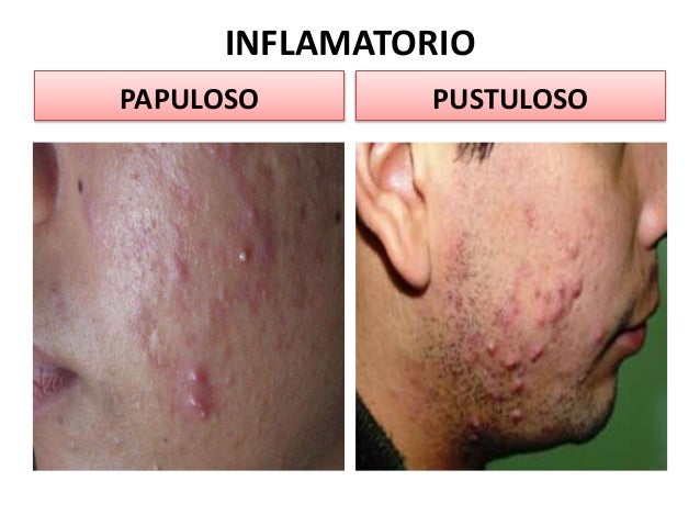 Resultado de imagen para acne papuloso