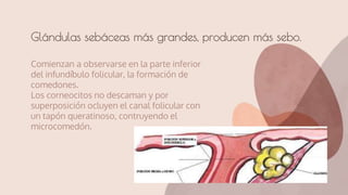 Comienzan a observarse en la parte inferior
del infundíbulo folicular, la formación de
comedones.
Los corneocitos no descaman y por
superposición ocluyen el canal folicular con
un tapón queratinoso, contruyendo el
microcomedón.
Glándulas sebáceas más grandes, producen más sebo.
 