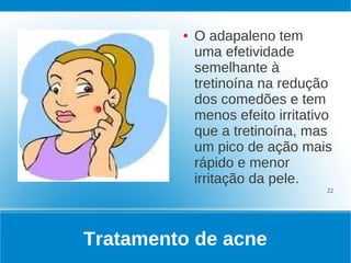 ●   O adapaleno tem
             uma efetividade
             semelhante à
             tretinoína na redução
             dos comedões e tem
             menos efeito irritativo
             que a tretinoína, mas
             um pico de ação mais
             rápido e menor
             irritação da pele.
                                   22




Tratamento de acne
 