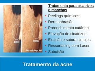 Tratamento para cicatrizes
            e manchas
        ●   Peelings químicos:
        ●   Dermoabrasão
        ●   Preenchimento cutâneo
        ●   Elevação de cicatrizes
        ●   Excisão e sutura simples
        ●   Ressurfacing com Laser
        ●   Subcisão                 42




Tratamento da acne
 