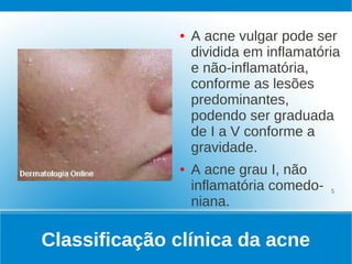 ●   A acne vulgar pode ser
                  dividida em inflamatória
                  e não-inflamatória,
                  conforme as lesões
                  predominantes,
                  podendo ser graduada
                  de I a V conforme a
                  gravidade.
              ●   A acne grau I, não
                  inflamatória comedo-   5

                  niana.

Classificação clínica da acne
 