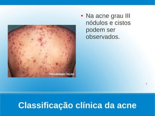 ●   Na acne grau III
                   nódulos e cistos
                   podem ser
                   observados.




                                      7




Classificação clínica da acne
 
