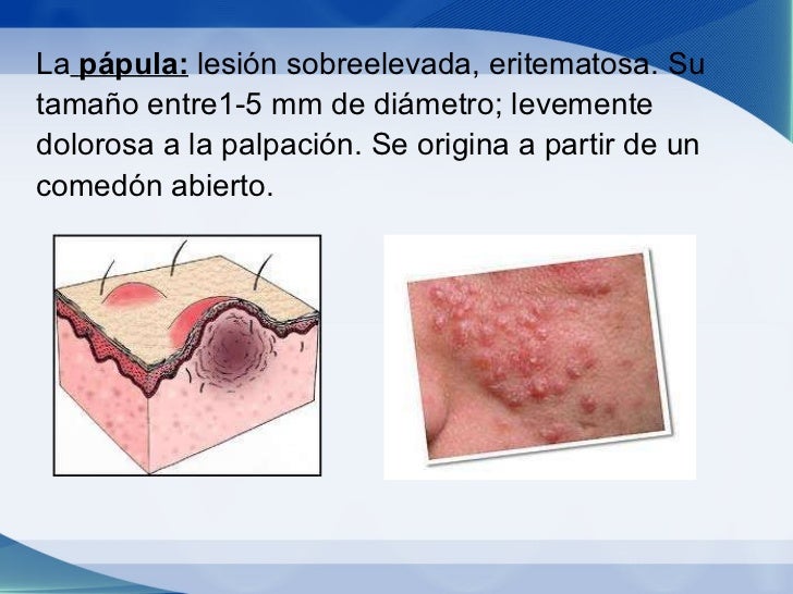 (2011-11-10) Acne.ppt