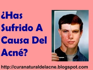 ¿Has
Sufrido A
Causa Del
Acné?
http://curanaturaldelacne.blogspot.com

 