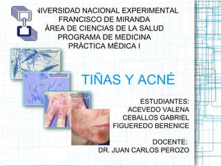 UNIVERSIDAD NACIONAL EXPERIMENTAL
FRANCISCO DE MIRANDA
ÁREA DE CIENCIAS DE LA SALUD
PROGRAMA DE MEDICINA
PRÁCTICA MÉDICA I

TIÑAS Y ACNÉ
ESTUDIANTES:
ACEVEDO VALENA
CEBALLOS GABRIEL
FIGUEREDO BERENICE
DOCENTE:
DR. JUAN CARLOS PEROZO

 