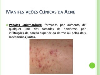 MANIFESTAÇÕES CLÍNICAS DA ACNE 
Pápulas inflamatórias: formadas por aumento de qualquer uma das camadas da epiderme, por infiltrações da porção superior da derme ou pelos dois mecanismos juntos.  