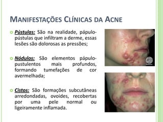 MANIFESTAÇÕES CLÍNICAS DA ACNE 
Pústulas: São na realidade, pápulo- pústulas que infiltram a derme, essas lesões são dolorosas as pressões; 
Nódulos: São elementos pápulo- pustulentos mais profundos, formando tumefações de cor avermelhada; 
Cistos: São formações subcutâneas arredondadas, ovoides, recobertas por uma pele normal ou ligeiramente inflamada.  