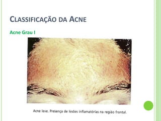 CLASSIFICAÇÃO DA ACNE 
Acne Grau I  