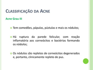 CLASSIFICAÇÃO DA ACNE 
Acne Grau III 
Tem comedões, pápulas, pústulas e mais os nódulos; 
Há ruptura da parede folicular, com reação inflamatória aos corneócitos e bactérias formando os nódulos; 
Os nódulos são repletos de corneócitos degenerados e, portanto, clinicamente repleto de pus.  