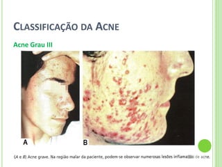 CLASSIFICAÇÃO DA ACNE 
Acne Grau III  