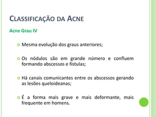 CLASSIFICAÇÃO DA ACNE 
Acne Grau IV 
Mesma evolução dos graus anteriores; 
Os nódulos são em grande número e confluem formando abscessos e fístulas; 
Há canais comunicantes entre os abscessos gerando as lesões queloideanas; 
É a forma mais grave e mais deformante, mais frequente em homens.  