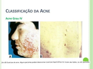 CLASSIFICAÇÃO DA ACNE 
Acne Grau IV  