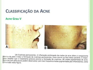 CLASSIFICAÇÃO DA ACNE 
Acne Grau V  