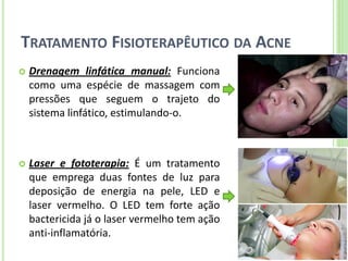 TRATAMENTO FISIOTERAPÊUTICO DA ACNE 
Drenagem linfática manual: Funciona como uma espécie de massagem com pressões que seguem o trajeto do sistema linfático, estimulando-o. 
Laser e fototerapia: É um tratamento que emprega duas fontes de luz para deposição de energia na pele, LED e laser vermelho. O LED tem forte ação bactericida já o laser vermelho tem ação anti-inflamatória.  