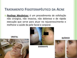 TRATAMENTO FISIOTERAPÊUTICO DA ACNE 
Peelings Mecânicos: é um procedimento de esfoliação não cirúrgico, não invasivo, não doloroso e de rápida execução que serve para atuar no rejuvenescimento e melhorar a saúde da pele facial e corporal.  