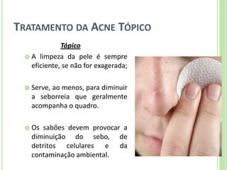 TRATAMENTO DA ACNE TÓPICO 
Tópico 
A limpeza da pele é sempre eficiente, se não for exagerada; 
Serve, ao menos, para diminuir a seborreia que geralmente acompanha o quadro. 
Os sabões devem provocar a diminuição do sebo, de detritos celulares e da contaminação ambiental.  