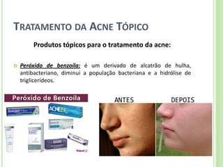TRATAMENTO DA ACNE TÓPICO 
Produtos tópicos para o tratamento da acne: 
Peróxido de benzoíla: é um derivado de alcatrão de hulha, antibacteriano, diminui a população bacteriana e a hidrólise de triglicerídeos.  
