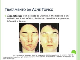 TRATAMENTO DA ACNE TÓPICO 
Ácido retinoico: é um derivado da vitamina A. O adapaleno é um derivado do ácido naftoico, diminui os comedões e o processo inflamatório da acne.  