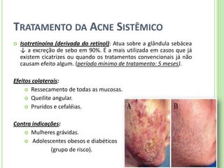 TRATAMENTO DA ACNE SISTÊMICO 
Isotretinoína (derivada do retinol): Atua sobre a glândula sebácea ↓ a excreção de sebo em 90%. É a mais utilizada em casos que já existem cicatrizes ou quando os tratamentos convencionais já não causam efeito algum. (período mínimo de tratamento: 5 meses). 
Efeitos colaterais: 
Ressecamento de todas as mucosas. 
Queilite angular. 
Pruridos e cefaléias. 
Contra indicações: 
Mulheres grávidas. 
 Adolescentes obesos e diabéticos 
(grupo de risco).  