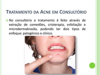 TRATAMENTO DA ACNE EM CONSULTÓRIO 
No consultório o tratamento é feito através de extração de comedões, crioterapia, esfoliação e microdermabrasão, podendo ter dois tipos de enfoque: patogênico e clínico.  