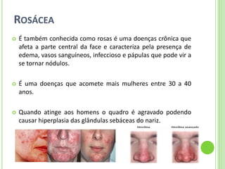 ROSÁCEA 
É também conhecida como rosas é uma doenças crônica que afeta a parte central da face e caracteriza pela presença de edema, vasos sanguíneos, infeccioso e pápulas que pode vir a se tornar nódulos. 
É uma doenças que acomete mais mulheres entre 30 a 40 anos. 
Quando atinge aos homens o quadro é agravado podendo causar hiperplasia das glândulas sebáceas do nariz.  