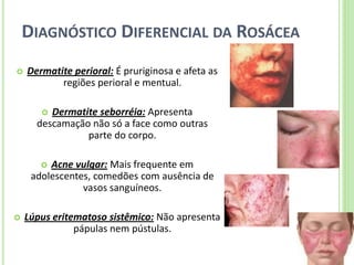 DIAGNÓSTICO DIFERENCIAL DA ROSÁCEA 
Dermatite perioral: É pruriginosa e afeta as regiões perioral e mentual. 
Dermatite seborréia: Apresenta descamação não só a face como outras parte do corpo. 
Acne vulgar: Mais frequente em adolescentes, comedões com ausência de vasos sanguíneos. 
Lúpus eritematoso sistêmico: Não apresenta pápulas nem pústulas.  