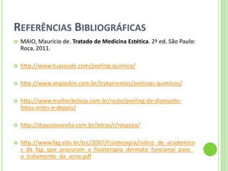 REFERÊNCIAS BIBLIOGRÁFICAS 
MAIO, Maurício de. Tratado de Medicina Estética. 2ª ed. São Paulo: Roca, 2011. 
http://www.tuasaude.com/peeling-quimico/ 
http://www.angioskin.com.br/tratamentos/peelings-quimicos/ 
http://www.mulherbeleza.com.br/rosto/peeling-de-diamante- fotos-antes-e-depois/ 
http://drauziovarella.com.br/letras/r/rosacea/ 
http://www.fag.edu.br/tcc/2007/Fisioterapia/indice_de_academicos_da_fag_que_procuram_a_fisioterapia_dermato_funcional_para_ o_tratamento_da_acne.pdf  