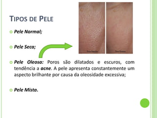 TIPOS DE PELE 
Pele Normal; 
Pele Seca; 
Pele Oleosa: Poros são dilatados e escuros, com tendência a acne. A pele apresenta constantemente um aspecto brilhante por causa da oleosidade excessiva; 
Pele Mista.  