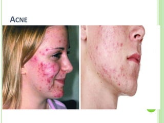 ACNE 
 