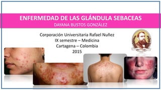 ENFERMEDAD DE LAS GLÁNDULA SEBACEAS
DAYANA BUSTOS GONZÁLEZ
Corporación Universitaria Rafael Nuñez
IX semestre – Medicina
Cartagena – Colombia
2015
 