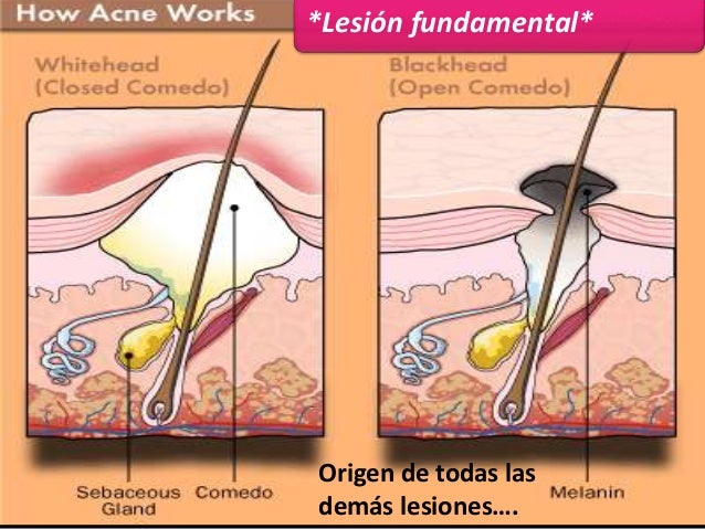 Tratamento tradicional de um acne