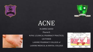 Acne (pimples)