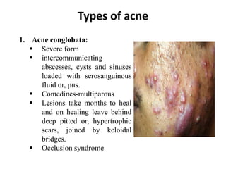 Types of acne
1. Acne conglobata:
 Severe form
 intercommunicating
abscesses, cysts and sinuses
loaded with serosanguinous
fluid or, pus.
 Comedines-multiparous
 Lesions take months to heal
and on healing leave behind
deep pitted or, hypertrophic
scars, joined by keloidal
bridges.
 Occlusion syndrome
 