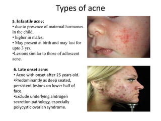 Types of acne
5. Infantile acne:
• due to presence of maternal hormones
in the child.
• higher in males.
• May present at birth and may last for
upto 3 yrs.
•Lesions similar to those of adloscent
acne.
6. Late onset acne:
• Acne with onset after 25 years old.
•Predominantly as deep seated,
persistent lesions on lower half of
face.
•Exclude underlying androgen
secretion pathology, especially
polycystic ovarian syndrome.
 