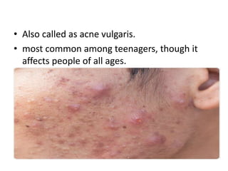• Also called as acne vulgaris.
• most common among teenagers, though it
affects people of all ages.
 