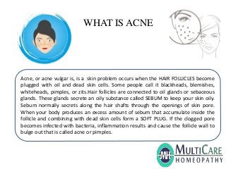 WHAT IS ACNE
Acne, or acne vulgar is, is a skin problem occurs when the HAIR FOLLICLES become
plugged with oil and dead skin cells. Some people call it blackheads, blemishes,
whiteheads, pimples, or zits.Hair follicles are connected to oil glands or sebaceous
glands. These glands secrete an oily substance called SEBUM to keep your skin oily.
Sebum normally secrets along the hair shafts through the openings of skin pore.
When your body produces an excess amount of sebum that accumulate inside the
follicle and combining with dead skin cells form a SOFT PLUG. If the clogged pore
becomes infected with bacteria, inflammation results and cause the follicle wall to
bulge out that is called acne or pimples.
 