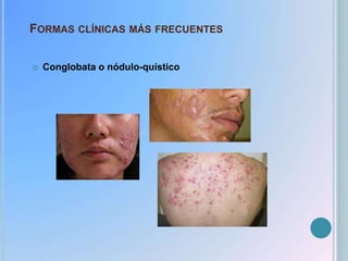 FORMAS CLÍNICAS MÁS FRECUENTES
 Conglobata o nódulo-quístico
 