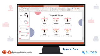 Types of Acne
Blackheads,
Whiteheads, Papules,
Pustules, and
Nodules
 