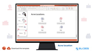 Acne location
Location of
acne includes
face, back,
neck, and
chest
 