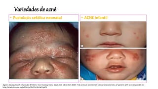 Variedades de acné
• Pustulosis cefálica neonatal
 Presentacion en las 2 primeras
semanas de vida (max 6 semanas)
 Papulas y pustulas usualmente
faciales
 Reaccion inflamatoria al
Malassezia spp.
• ACNE infantil
• Presentación entre 6 – 12
semanas
• Mas severo que acné neonatal
• Presencia de lesiones
inflamatorias.
• Puede durar 6 – 12 meses o por
varios años.
• Endocrinopatías (?)
Agüero de Zaputovich F, Samudio M .Mem. Inst. Investig. Cienc. Salud, Vol. 13(1) Abril 2020: 7-16 [articulo en internet] Clinical characteristics of patients with acne disponible en:
http://scielo.iics.una.py/pdf/iics/v13n1/v13n1a03.pdf3.
 